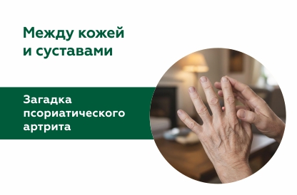 Псориатический артрит: симптомы и лечение